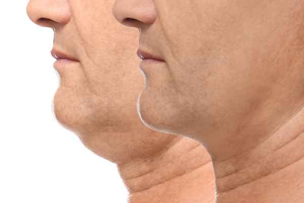 HIFU - Breakthrough in Anti - ageing 2 hifu results Chippenham