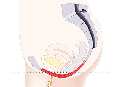 Pelvic-Floor Muscle Repair 5 Pelvic floor muscles Chippenham
