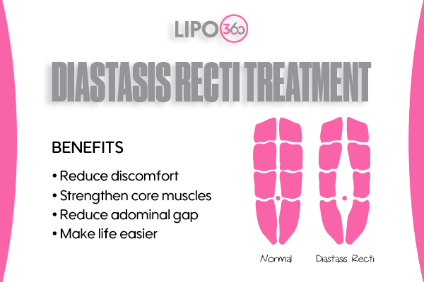 Revolutionising Muscle Repair: The Power of LIPO360 Body Sculpt Post-Injury 5 diastasis recti treatment Chippenham