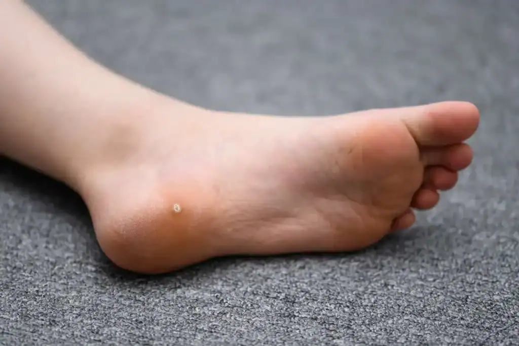 Cryotherapy For Warts And Also Verrucas 2 Image of verruca on the bottom of the foot that able to be treated with Cryotherapy Chippenham