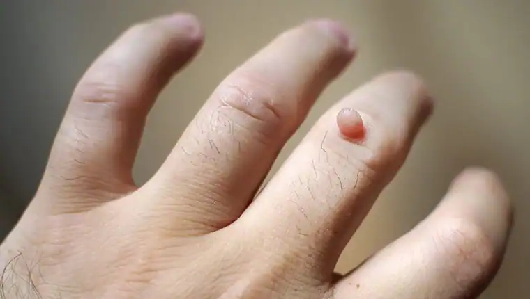 Image of blemish that Cryotherapy Chippenham can remove with Lipo 360.