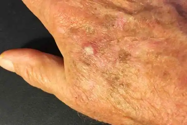 Image of Actinic keratoses Chippenham on a person hand